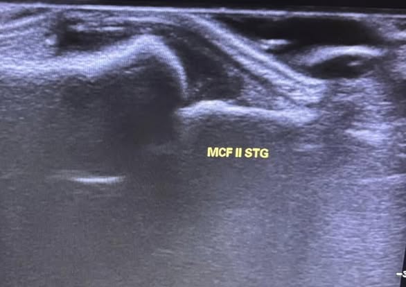 Ecografie articulară MCF II